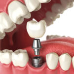 Complete Your Smile with Dental Implants