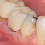 Tips about Receding Gums